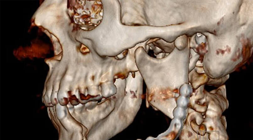 planejamento virtual da cirurgia reconstrutiva