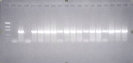 Aspectos Clínicos E Histológicos En La Queilitis Actínica Crónica, Su Relación Con El Virus Del Papiloma Humano - 4