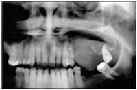 Mixoma Odontogênico Com Invasão Sinusal