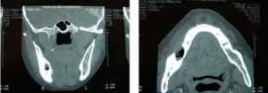 Osteonecrose Dos Maxilares Associada Ao Uso De Bisfosfonatos