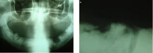 Osteonecrose Dos Maxilares Associada Ao Uso De Bisfosfonatos