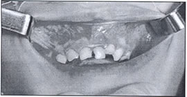 Trauma-Induced Dentigerous Cyst Involving The Anterior Maxilla