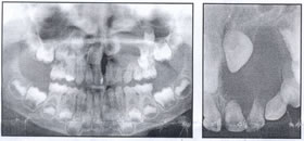 Trauma-Induced Dentigerous Cyst Involving The Anterior Maxilla