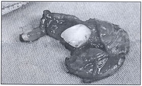 Trauma-Induced Dentigerous Cyst Involving The Anterior Maxilla