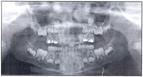 Trauma-Induced Dentigerous Cyst Involving The Anterior Maxilla