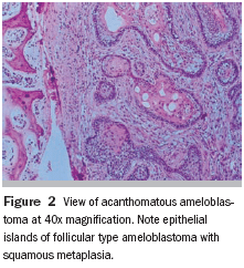 Unilocular Ameloblastoma Simulating Periapical Cyst The Importance Of Histopathological Exam
