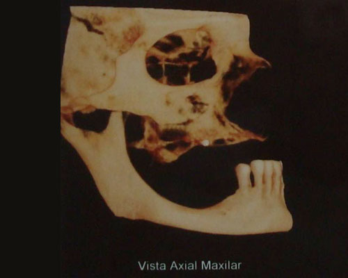 Visão lateral do crânio demonstrando grande atrofia óssea da maxila