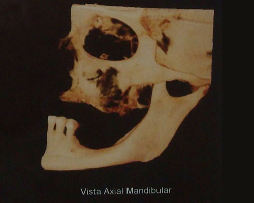Visão lateral do crânio demonstrando grande atrofia óssea da maxila