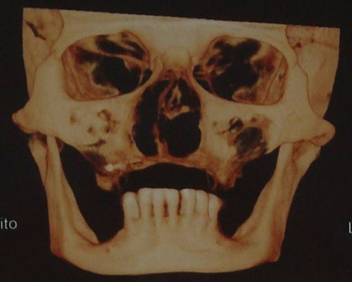 Visão tridimensional do crânio demonstrando grande atrofia óssea da maxila