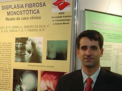 trabalho de displasia fibrosa