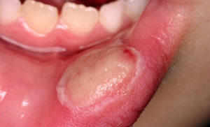 atendimento odontológico para pacientes oncológicos