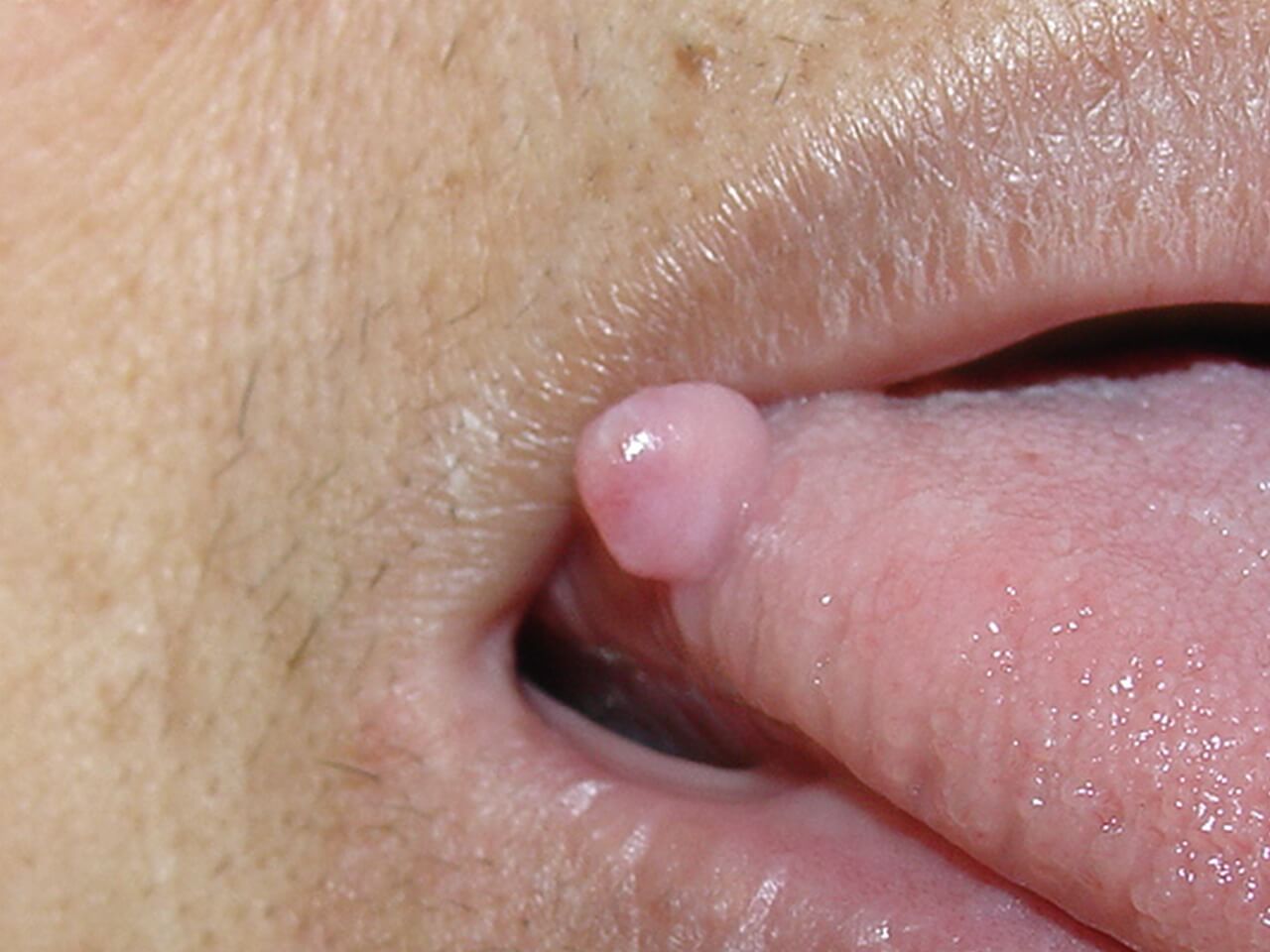 Estomatologia Fibroma