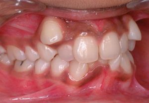má oclusão dentária